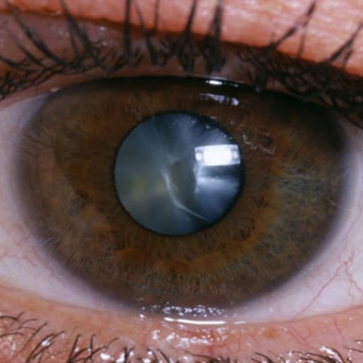 Как происходит лечение катаракты