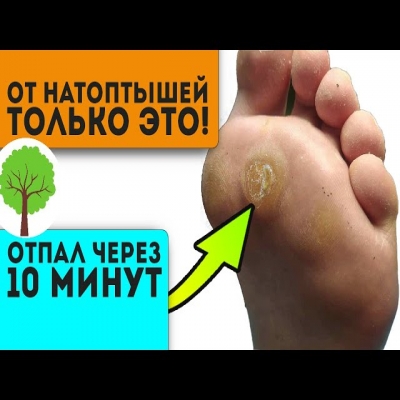 Пятки были похожи на копыта, но после смеси лимонного сока с ... Кожа как у младенца!