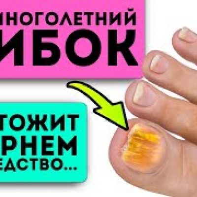 Вот как навсегда избавиться от грибка на любой части тела