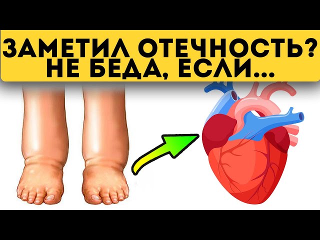 Прежде, чем есть химию при отёках, каждый должен узнать это! Причина отёков, сердце...