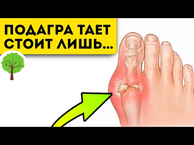 Тотальная чистка суставов от мочевой кислоты! Навсегда забыл о боли после настоя...